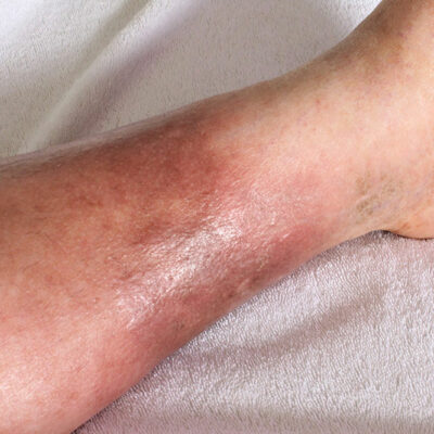 4 Common Treatments for DVT