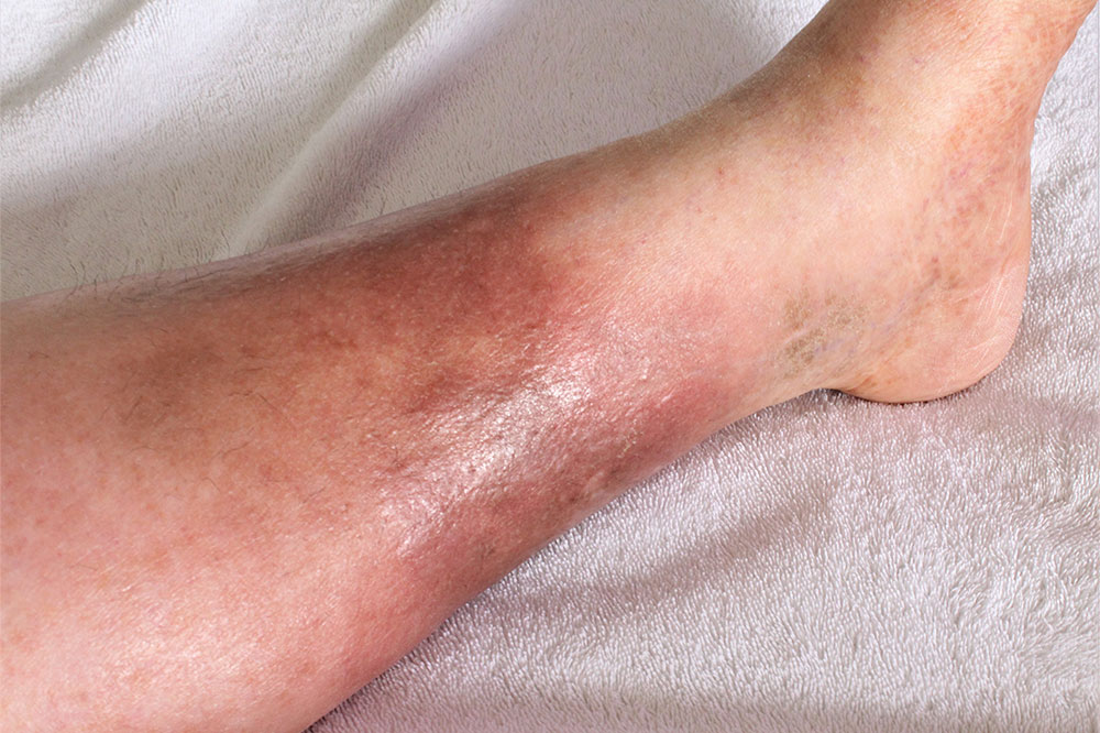 4 Common Treatments for DVT
