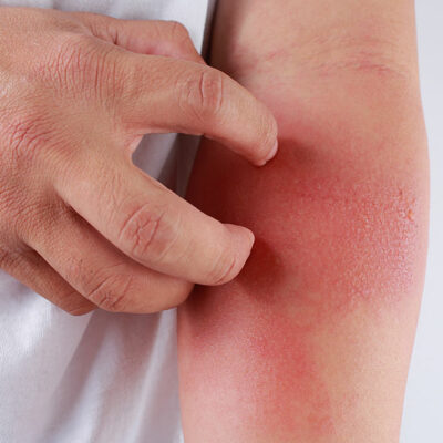 5 Polluted Cities That Can Aggravate Eczema