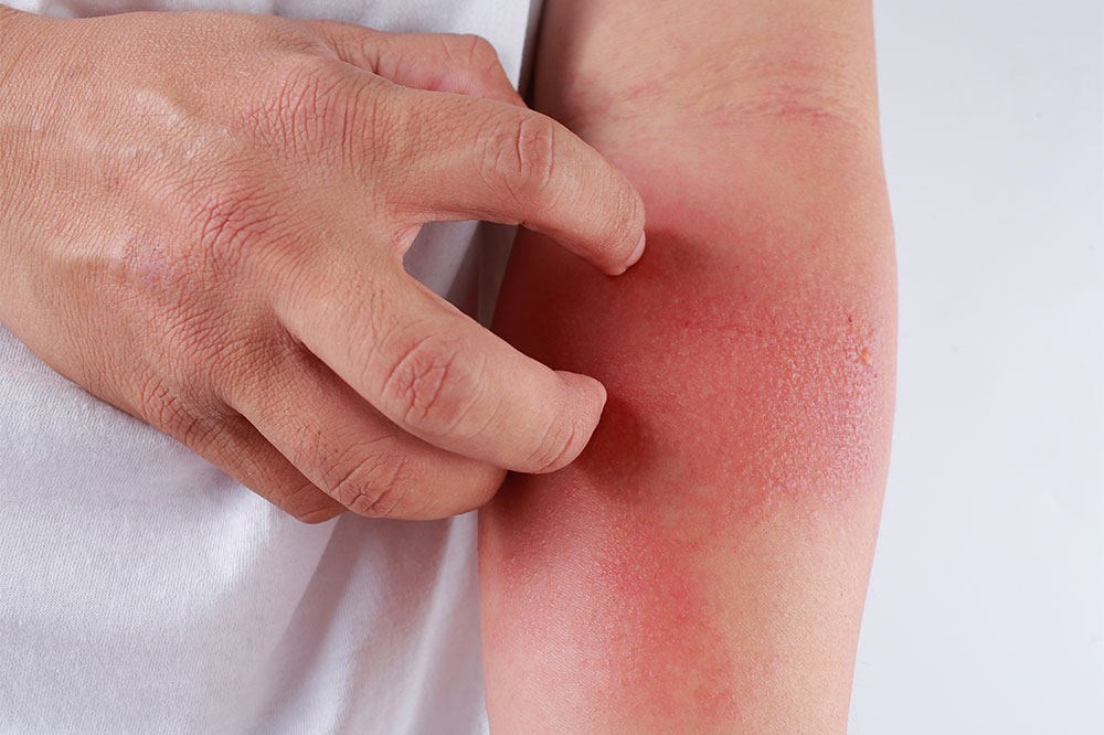 5 Polluted Cities That Can Aggravate Eczema