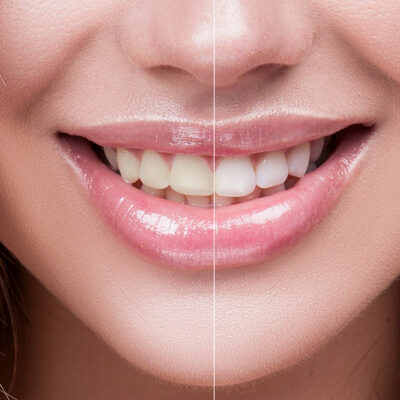 Natural Teeth Whitening – Myths and Facts
