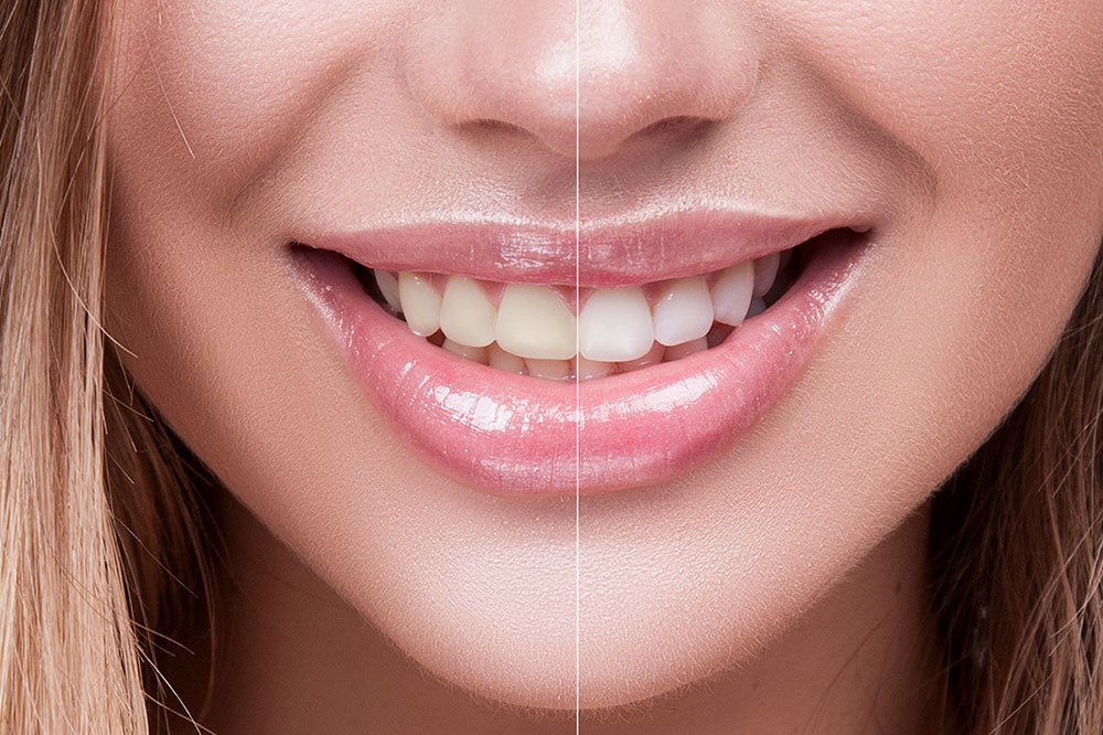Natural Teeth Whitening – Myths and Facts